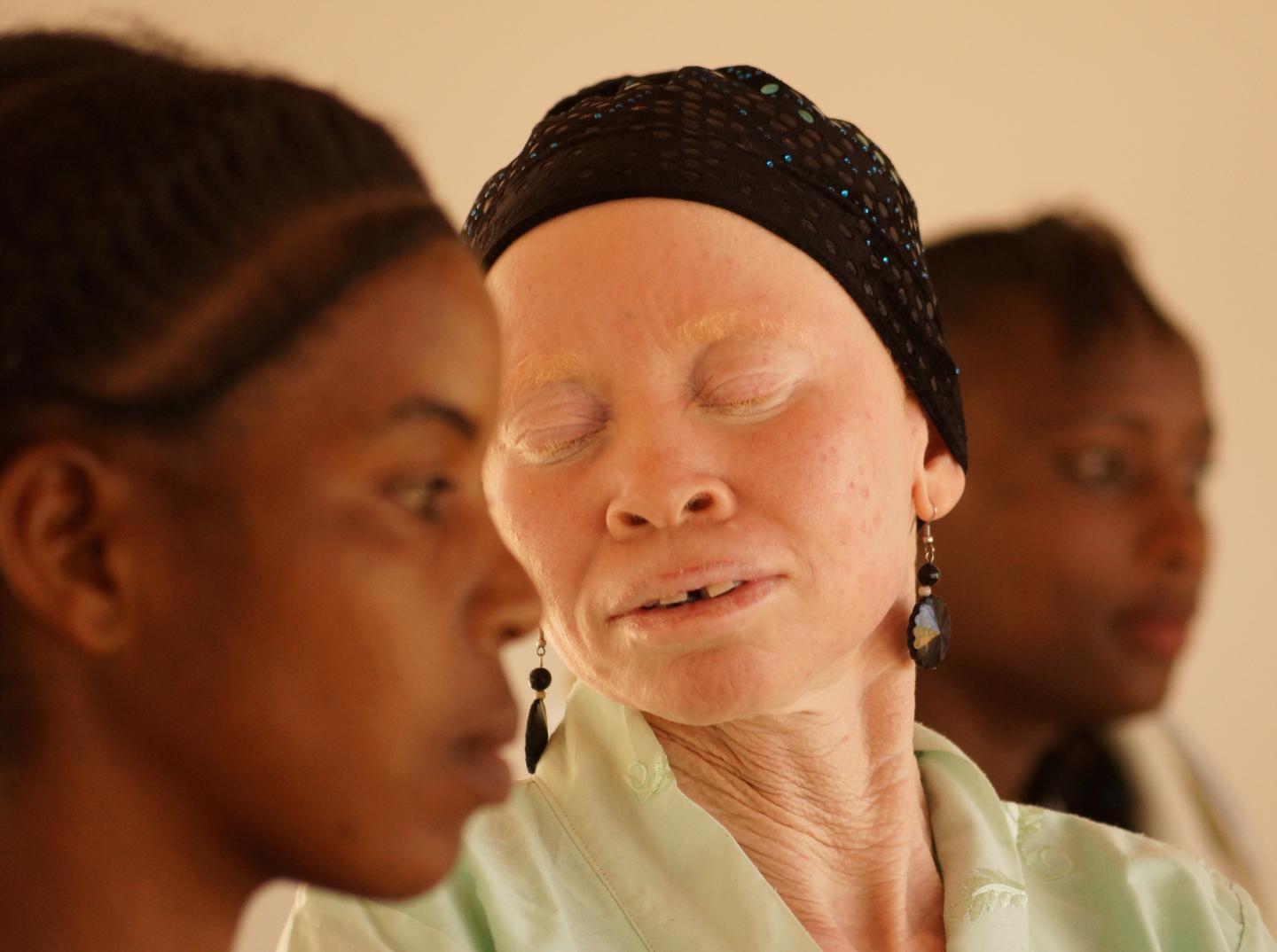 Newsweek in depth feature of Tantazia Albinism Collective