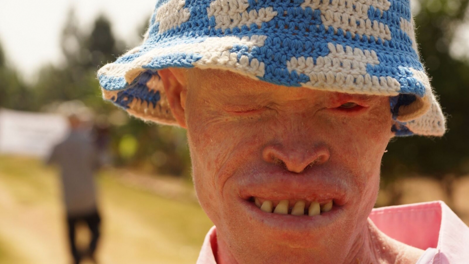 PRI’s The world feature Tanzania Albinism Collective
